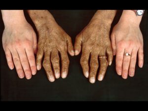 Hemochromatosis symptoms