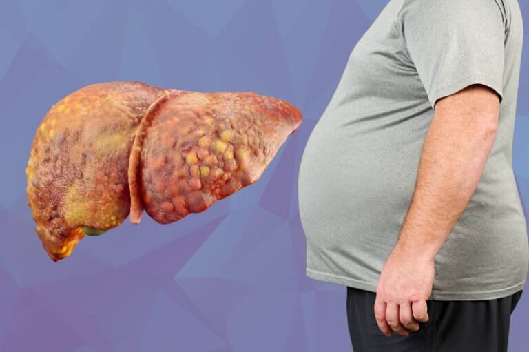 The Non Alcoholic Fatty Liver Disease Solution review: fuss?